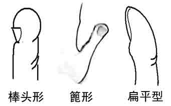棒头型,篦形,扇形,扁平形拇指